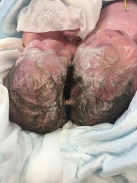«Удалили кожный лоскут»: московские хирурги рассказали о разделении сиамских близнецов