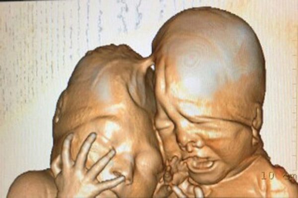 «Удалили кожный лоскут»: московские хирурги рассказали о разделении сиамских близнецов