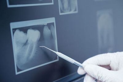 Минздрав предложил оснащать кабинеты стоматологии рентгеном при определенных условиях