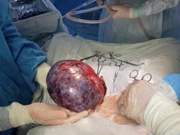 Подмосковные врачи удалили женщине опухоль яичника размером 25 см